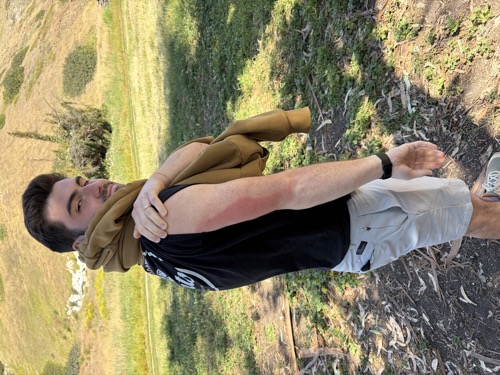 Matt Kahler showing off a sunburned shoulder